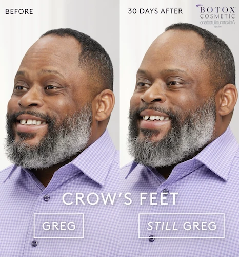 BOTOX Before and After - Greg