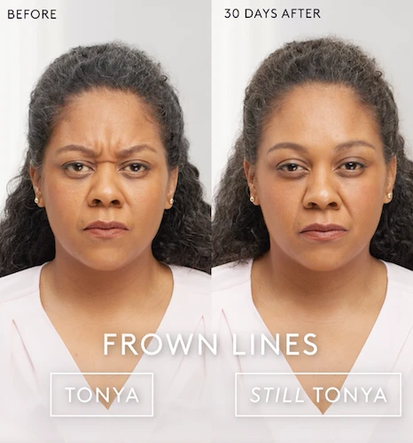 BOTOX Before and After - Tonya