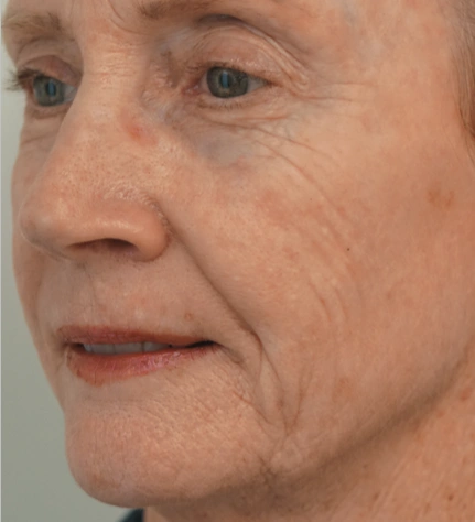 Photofacial After
