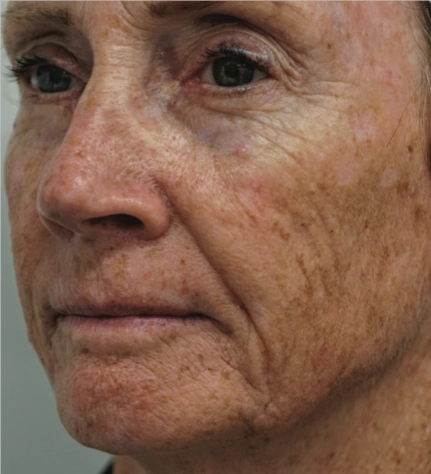 Photofacial Before