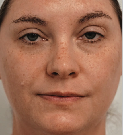 Photofacial Before 4