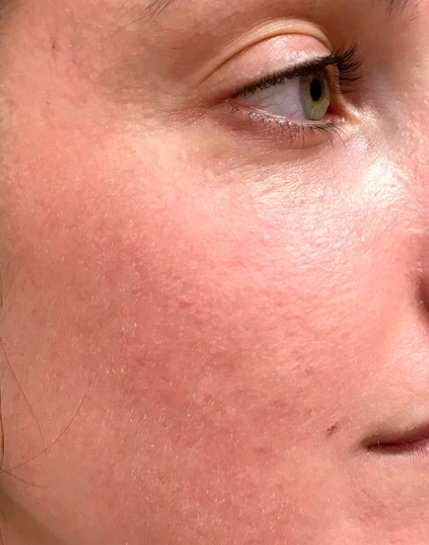 Sciton HALO Before and After 5-5