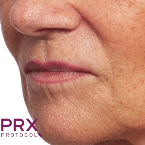 PRX Protocol Before 3