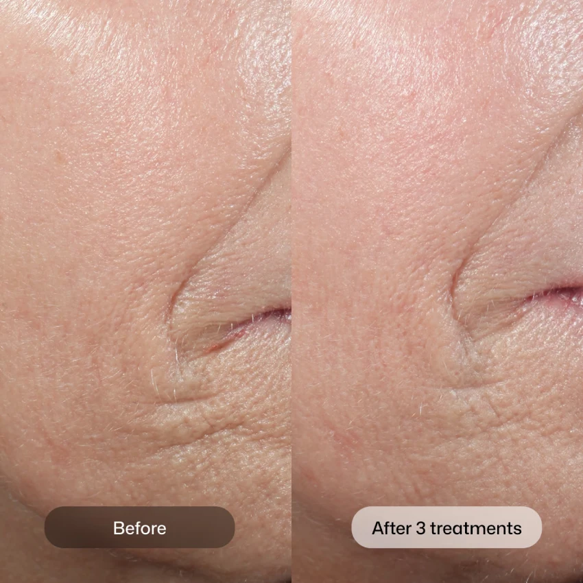 Biostim before and after 1